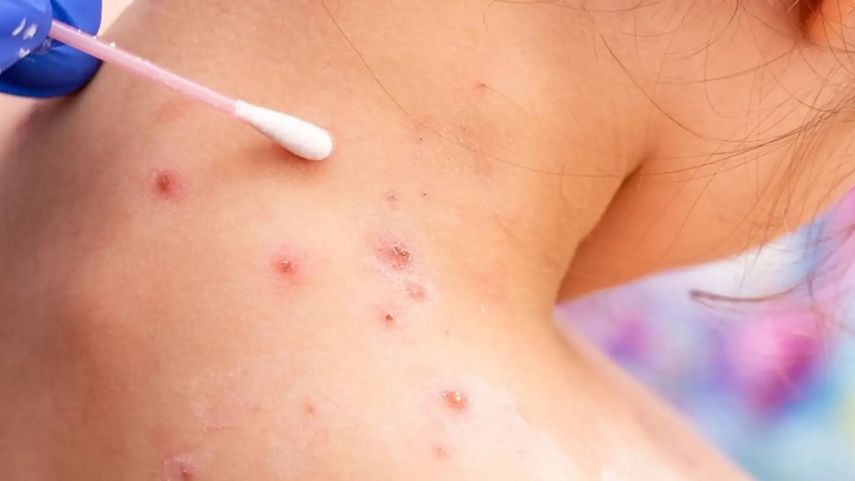 La Organización Mundial de la Salud (OMS) indicó este lunes que mantiene la alerta por la epidemia de mpox, que afecta principalmente a Africa, y pidió "apoyo internacional continuado". La Organización Mundial de la Salud (OMS) indicó este lunes que mantiene la alerta por la epidemia de mpox, que afecta principalmente a Africa, y pidió "apoyo internacional continuado".