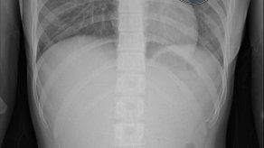 Nuevo sistema de inteligencia artificial para detectar anomalías por COVID-19