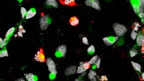 Estudio demuestra vínculo entre zika y daño cerebral en el feto