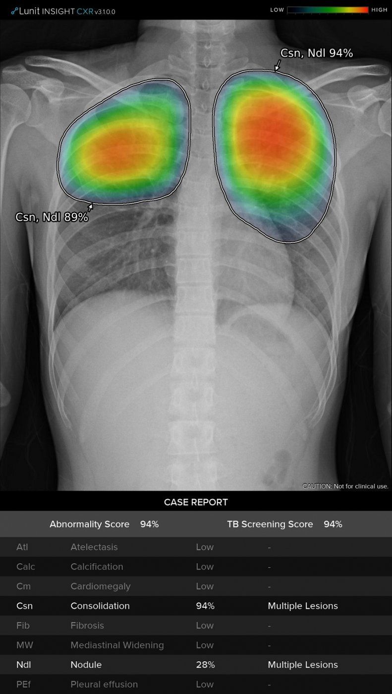 Nuevo sistema de inteligencia artificial para detectar anomalías por COVID-19