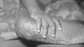 Panamá vigilante ante casos de viruela del mono