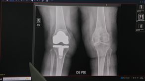 El Hospital Santo Tomás (HST) dio inicio a una nueva jornada de cirugías de reemplazo de rodilla en colaboración con la organización estadounidense Operation Walk, esto para mejorar la movilidad y la calidad de vida de decenas de panameños.