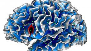 La profundidad de un pliegue cerebral puede ayudar a diagnosticar el autismo