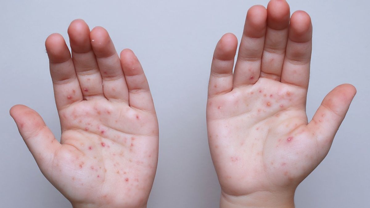 Ante el incremento sostenido de casos de sarampión en la región de las Américas, el Ministerio de Salud (Minsa), a través del Departamento Nacional de Epidemiología, informó que Panamá mantiene y refuerza sus acciones de vigilancia epidemiológica para la detección oportuna de casos sospechosos y la implementación inmediata de medidas de control. Ante el incremento sostenido de casos de sarampión en la región de las Américas, el Ministerio de Salud (Minsa), a través del Departamento Nacional de Epidemiología, informó que Panamá mantiene y refuerza sus acciones de vigilancia epidemiológica para la detección oportuna de casos sospechosos y la implementación inmediata de medidas de control.