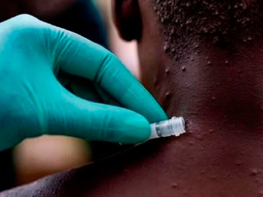 India notificó su primer caso de viruela del mono tras detectar el contagio de un hombre de 35 años que registró síntomas tras viajar a Medio Oriente, informaron las autoridades.