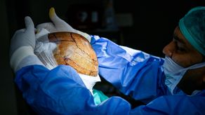 La moda de los trasplantes capilares esconde mortales peligros. ¿Qué debo saber?