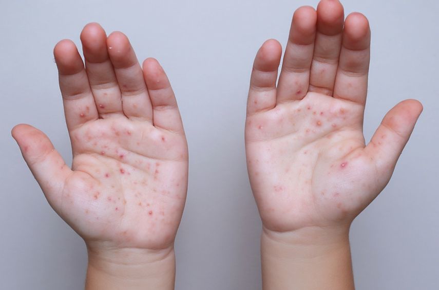 Ante el incremento sostenido de casos de sarampión en la región de las Américas, el Ministerio de Salud (Minsa), a través del Departamento Nacional de Epidemiología, informó que Panamá mantiene y refuerza sus acciones de vigilancia epidemiológica para la detección oportuna de casos sospechosos y la implementación inmediata de medidas de control. Ante el incremento sostenido de casos de sarampión en la región de las Américas, el Ministerio de Salud (Minsa), a través del Departamento Nacional de Epidemiología, informó que Panamá mantiene y refuerza sus acciones de vigilancia epidemiológica para la detección oportuna de casos sospechosos y la implementación inmediata de medidas de control.