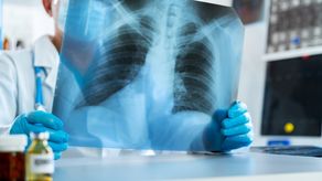 Panamá registra 812 casos de tuberculosis en lo que va del 2024