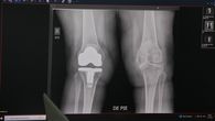 El Hospital Santo Tomás (HST) dio inicio a una nueva jornada de cirugías de reemplazo de rodilla en colaboración con la organización estadounidense Operation Walk, esto para mejorar la movilidad y la calidad de vida de decenas de panameños. El Hospital Santo Tomás (HST) dio inicio a una nueva jornada de cirugías de reemplazo de rodilla en colaboración con la organización estadounidense Operation Walk, esto para mejorar la movilidad y la calidad de vida de decenas de panameños.