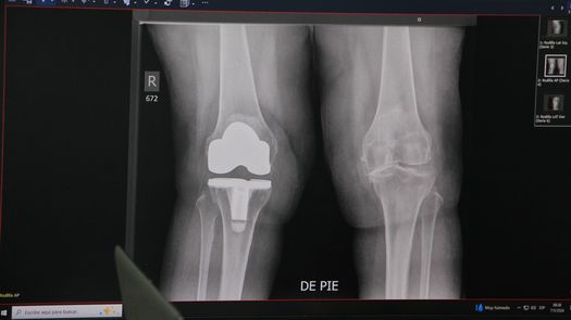 El Hospital Santo Tomás (HST) dio inicio a una nueva jornada de cirugías de reemplazo de rodilla en colaboración con la organización estadounidense Operation Walk, esto para mejorar la movilidad y la calidad de vida de decenas de panameños. El Hospital Santo Tomás (HST) dio inicio a una nueva jornada de cirugías de reemplazo de rodilla en colaboración con la organización estadounidense Operation Walk, esto para mejorar la movilidad y la calidad de vida de decenas de panameños.