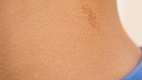 Neurofibromatosis: trastorno genético del sistema nervioso