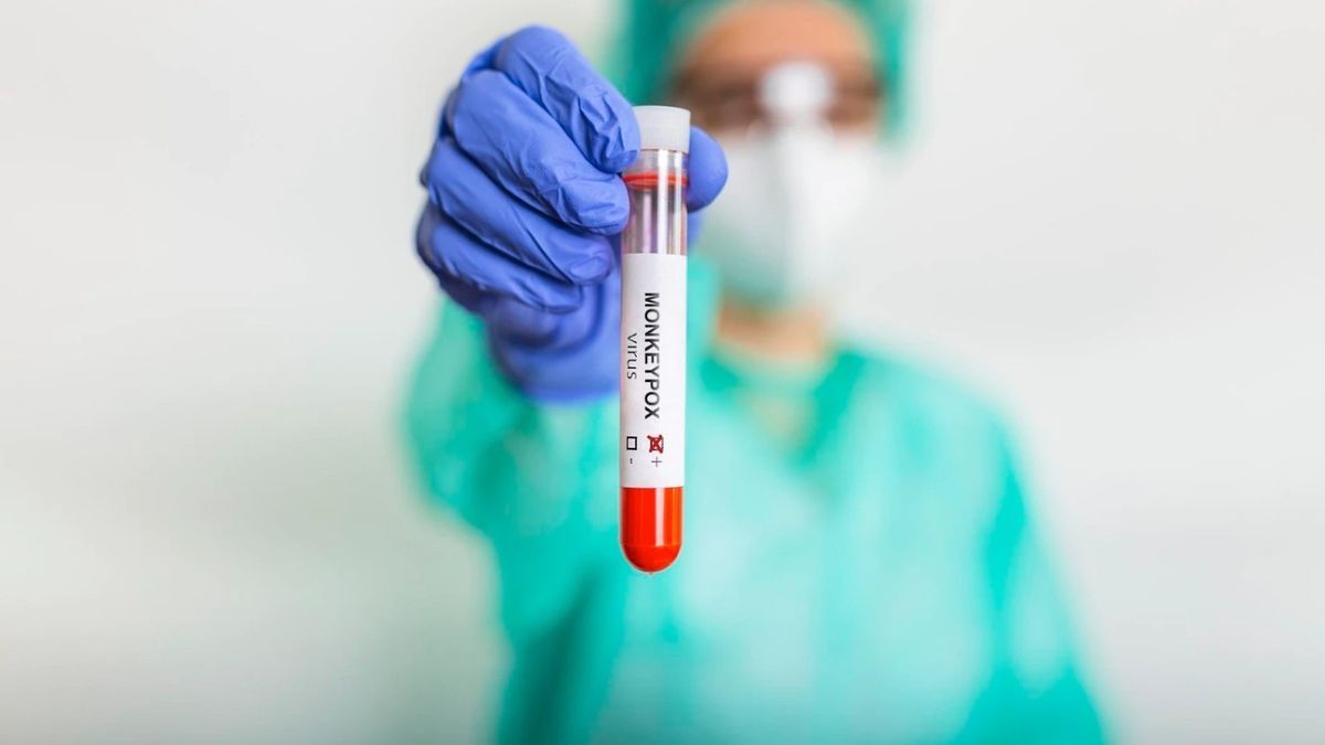 Casos de viruela símica incrementan a 22 en el país