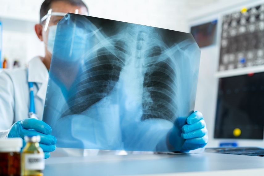 Panamá registra 812 casos de tuberculosis en lo que va del 2024