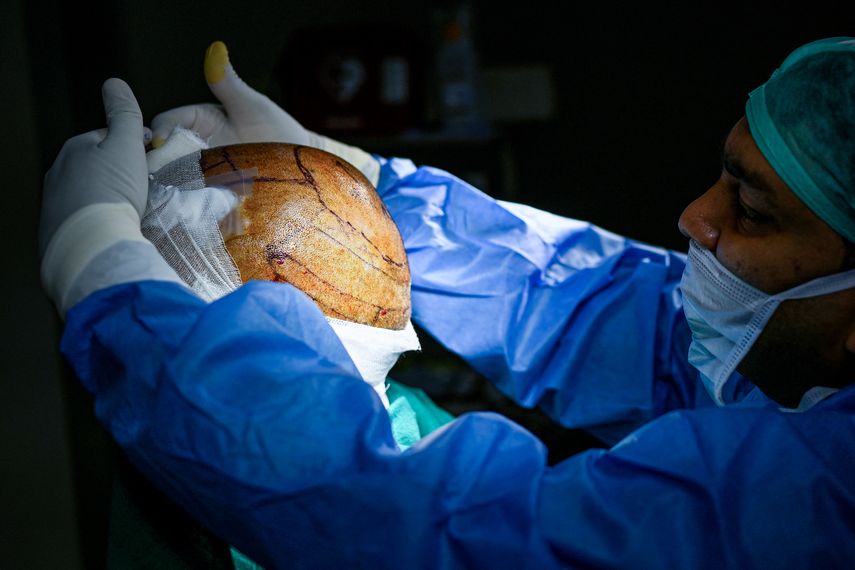 Athar Rasheed, un joven directivo de televisión en India, sufría una calvicie incipiente. Decidió someterse a un trasplante capilar con la esperanza de ser más atractivo y casarse, pero este procedimiento le costó la vida.