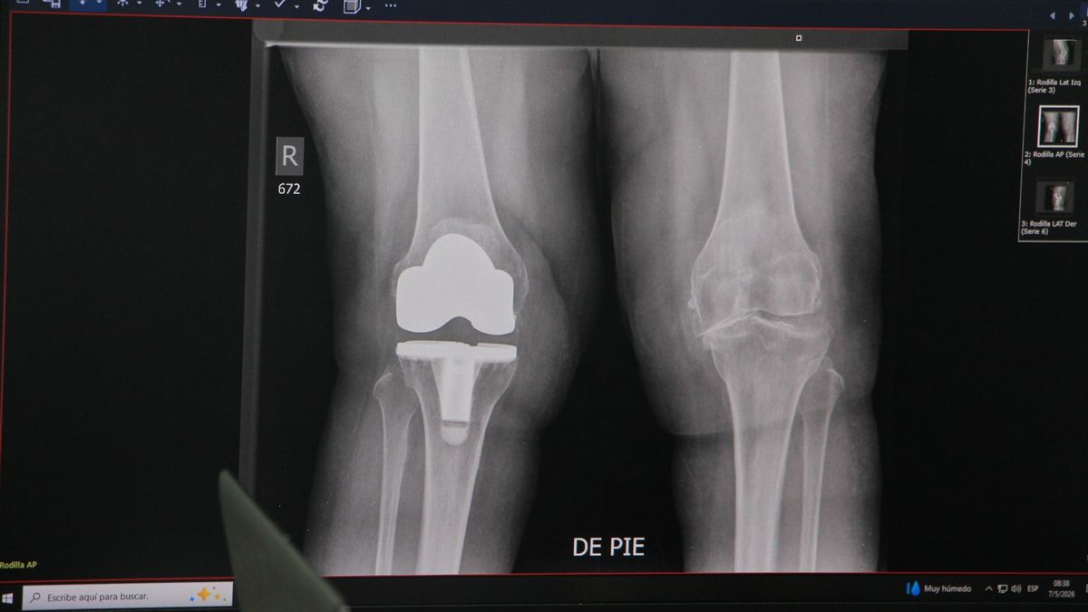 El Hospital Santo Tomás (HST) dio inicio a una nueva jornada de cirugías de reemplazo de rodilla en colaboración con la organización estadounidense Operation Walk, esto para mejorar la movilidad y la calidad de vida de decenas de panameños.