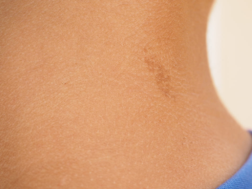 Neurofibromatosis: trastorno genético del sistema nervioso