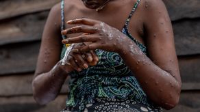 OMS mantiene su nivel máximo de alerta con respecto a la epidemia de mpox