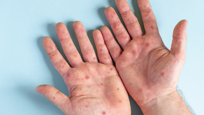 Minsa espera aumento de casos del virus de manos