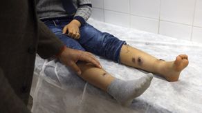Panamá registra 14 nuevos casos de Leishmaniasis